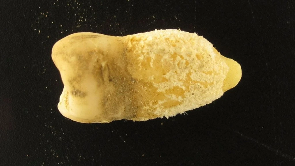 Ancient Bolivian Mummy Tooth Reshapes Scarlet Fever Origins