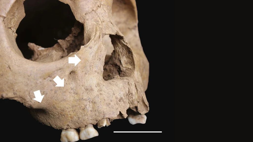 Ancient Teeth Reveal Syphilis-Like Disease in 4,000-Year-Old Vietnam Children