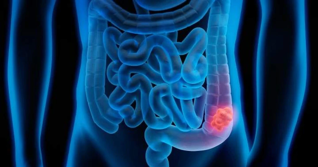 ACS Adds Blood Test to Colorectal Cancer Screening Options