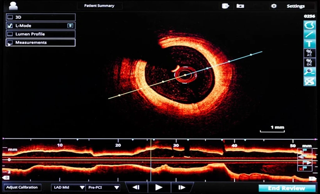 AI Boosts Confidence for OCT-Guided Heart Procedures at EuroPCR 2026