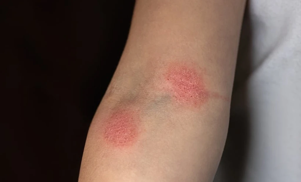Adult Hypopigmented Mycosis Fungoides Shows Low Progression Risk and Favorable Prognosis
