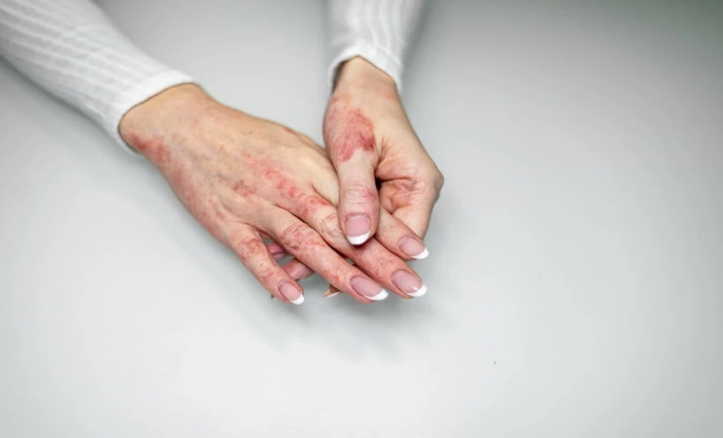 Abrocitinib Sustains Atopic Dermatitis Relief Over Two Years