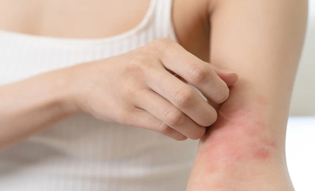 S1P Signaling Pathway Linked to Atopic Dermatitis Inflammation