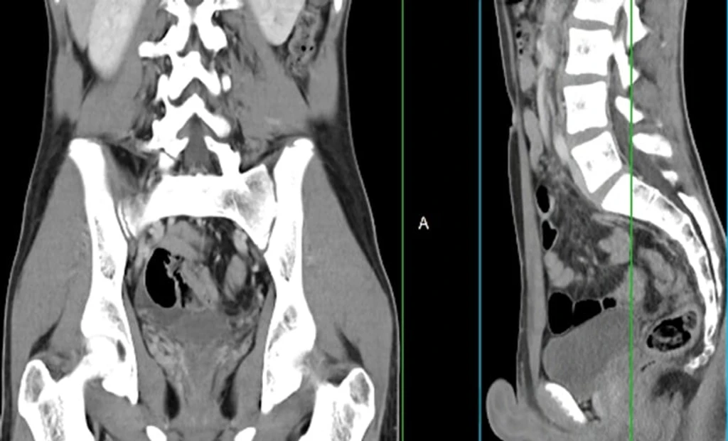 AI Accurately Detects Vertebral Fractures on CT Scans