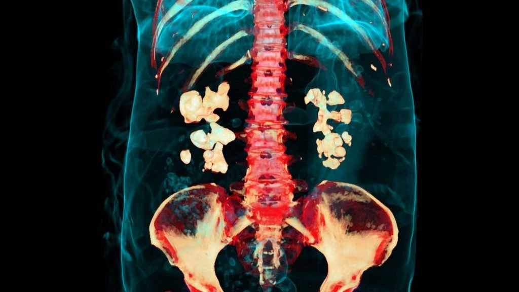 Bacteria Found Within Common Kidney Stones, Challenging Decades of Medical Belief