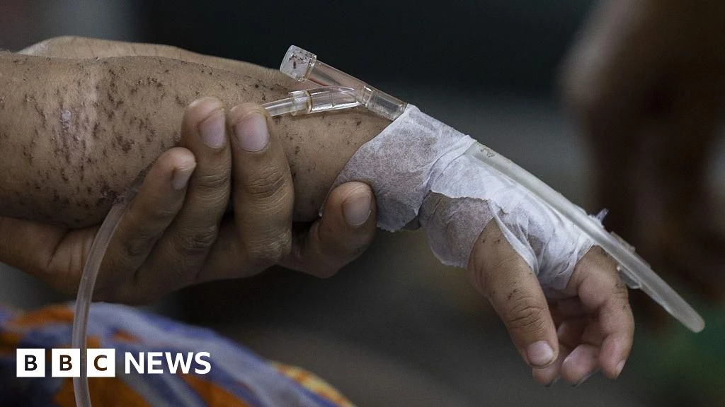 Measles Outbreak Kills Over 500 Children in Bangladesh Amid Vaccine Delays