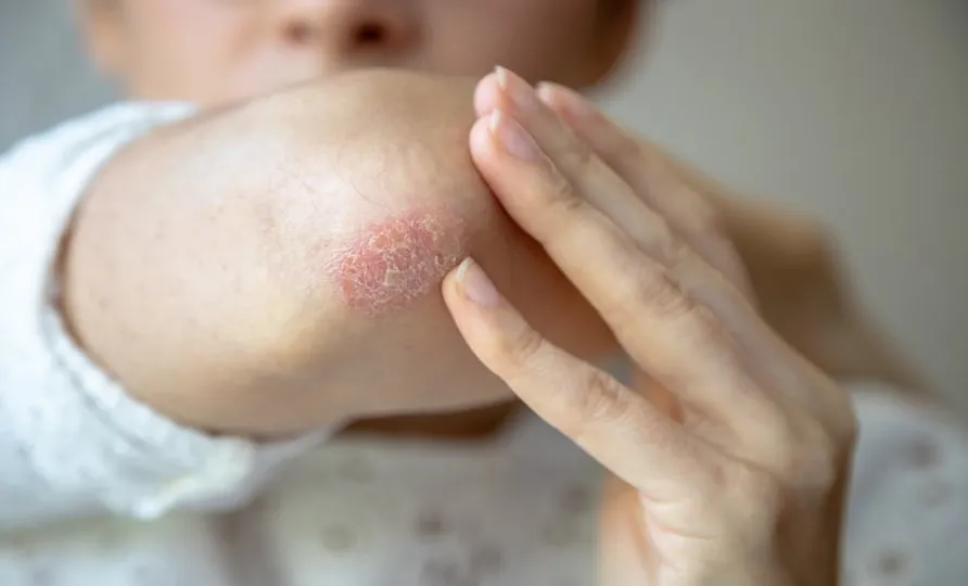 Bimekizumab Shows 3-Year Psoriasis Symptom and Quality of Life Improvements
