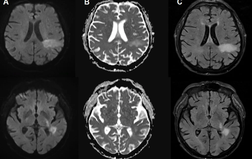 Silent Brain-Eating Virus Affects Millions