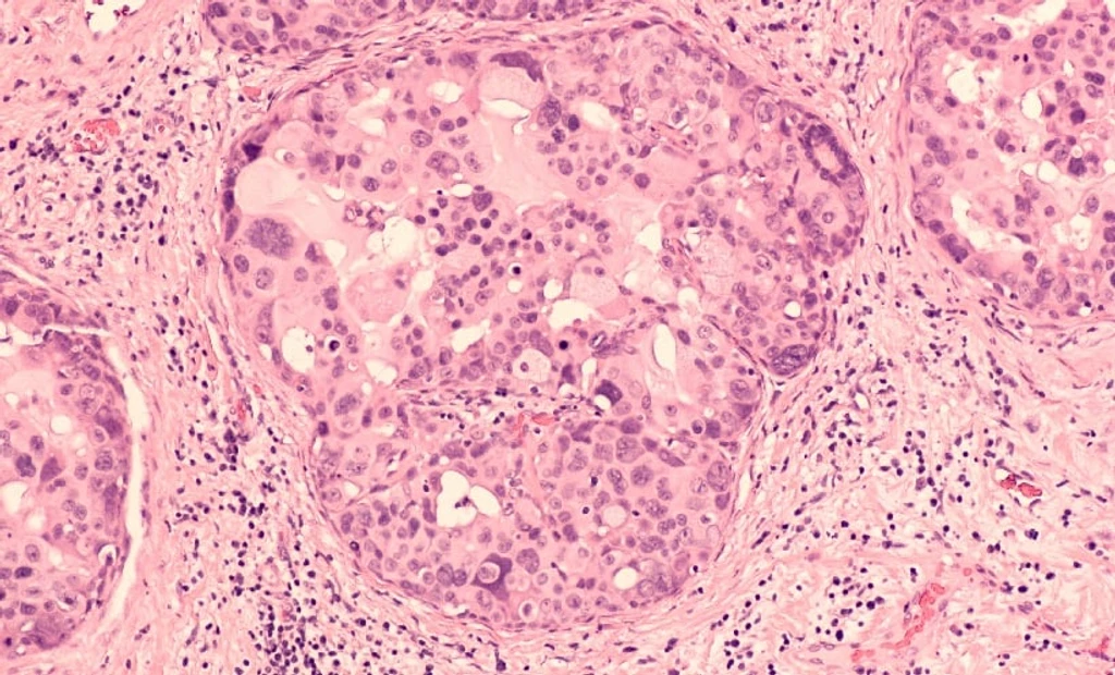 Contrast-Enhanced Mammography Boosts DCIS Detection