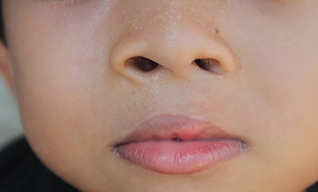 Cleft Palate Linked to Increased Mental Health and Developmental Risks