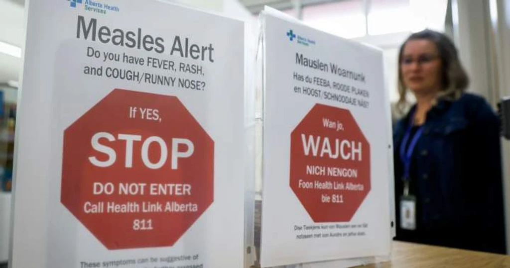 Measles Exposure Warning Issued for Calgary Medical Clinic