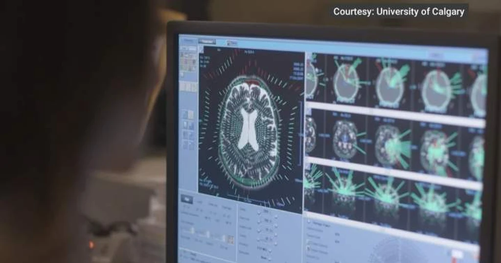Philanthropist's Legacy Fuels Groundbreaking Mental Health Research at University of Calgary