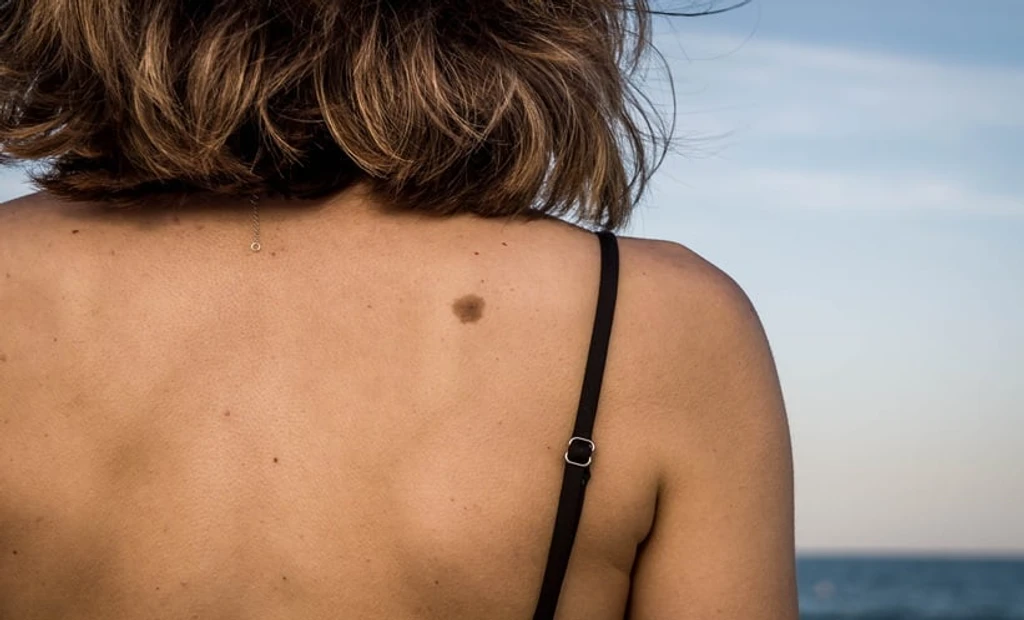 COVID-19 Lockdowns Linked to Drop in Melanoma Diagnoses, Study Finds