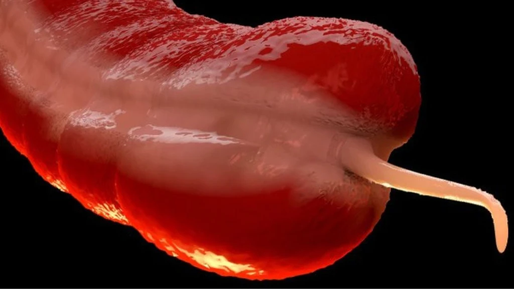 Rare Appendix Cancer Surges in Young People, Mystifying Experts