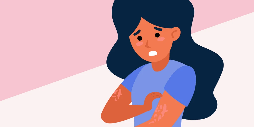 Understanding Chronic Spontaneous Urticaria