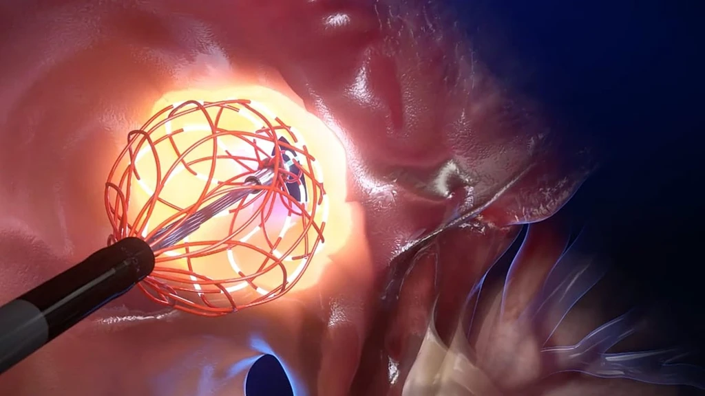Revolutionary Catheter Poised to Transform Arrhythmia Treatment