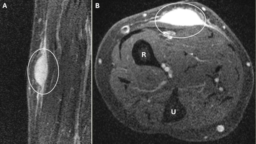 Biopsy Triggers Spontaneous Regression of Rare Arm Sarcoma