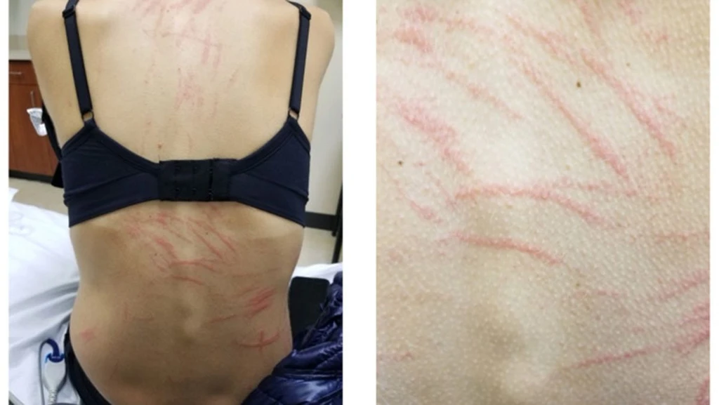 Shiitake Mushrooms Cause Whiplike Rash in New York Woman