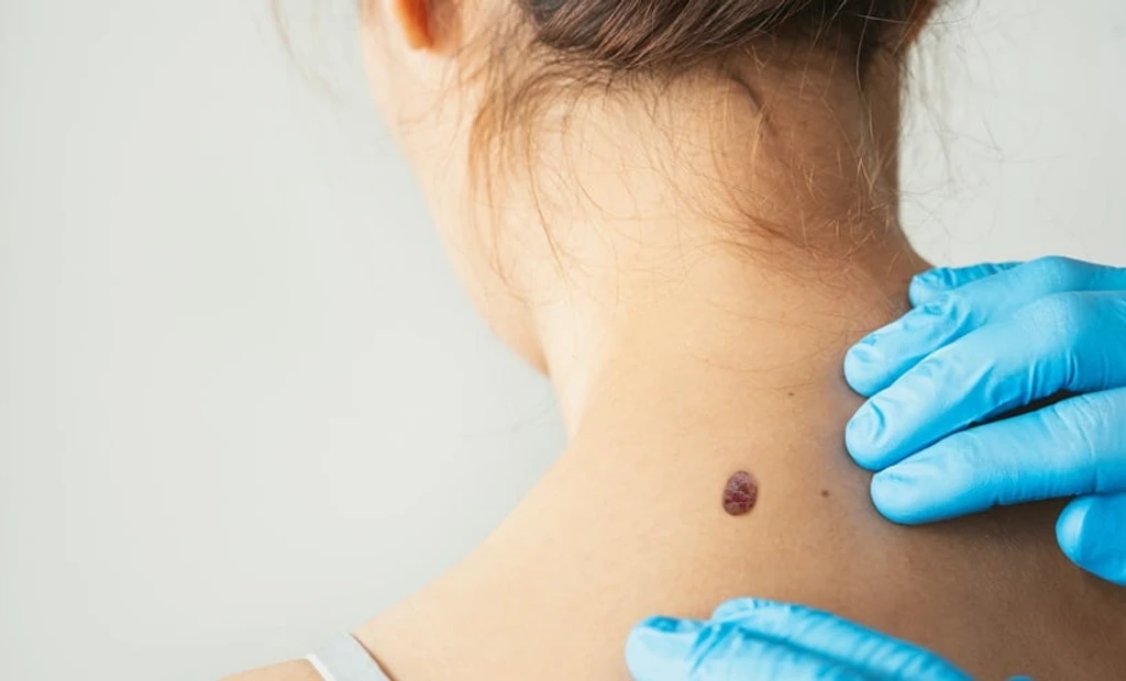 Expert Dermatologists Outperform AI Models in Real-World Skin Cancer Diagnosis