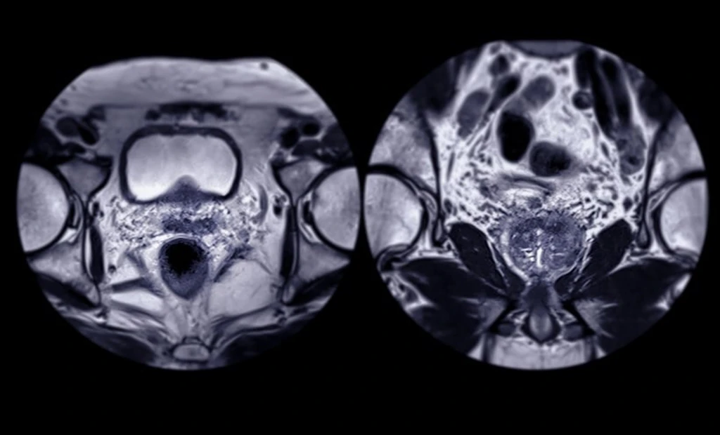 AI Boosts Prostate Cancer Biopsy Accuracy
