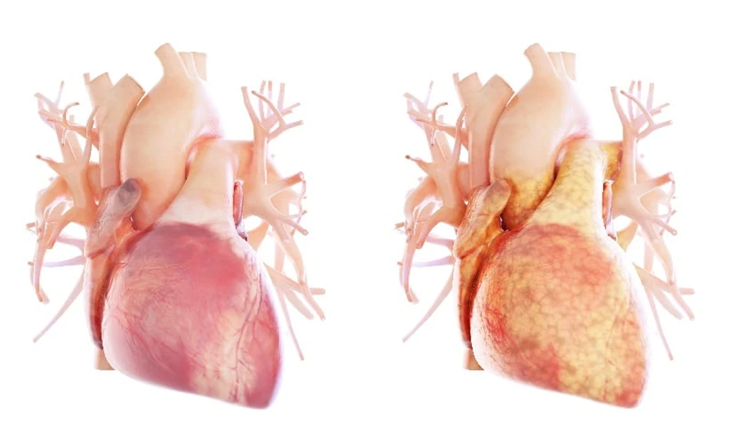 Epicardial Fat Index on MRI Predicts Heart Failure Risk