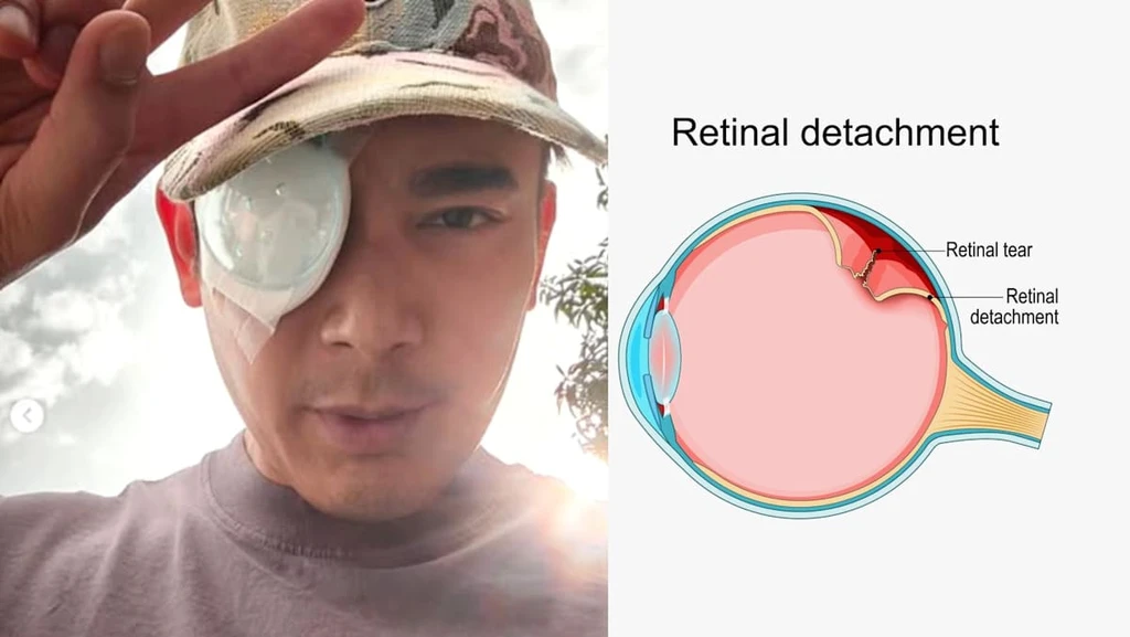 Actor Elvin Ng's Retinal Detachment: Understanding Myopia and Urgent Warning Signs