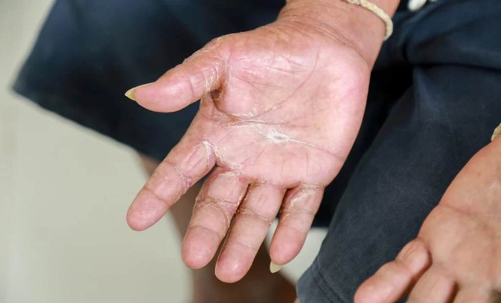 Early Lung Decline May Predict Systemic Sclerosis Progression