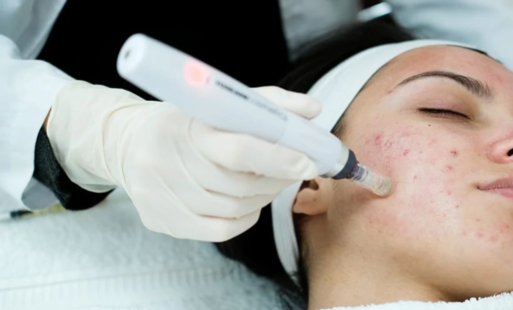CO2 Laser Outperforms Microneedling for Acne Scars