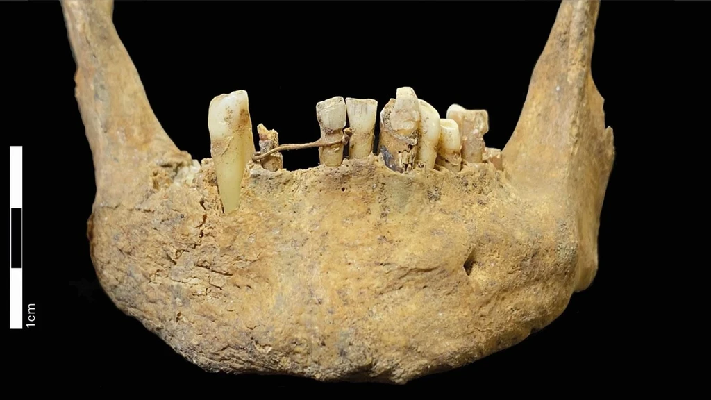 500-Year-Old Gold Dental Bridge Found in Scotland Is Earliest Known Oral Care of Its Kind