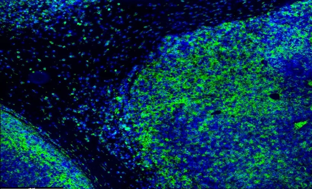 Atezolizumab-Bevacizumab Shows Efficacy in Select Child-Pugh B Liver Cancer Patients