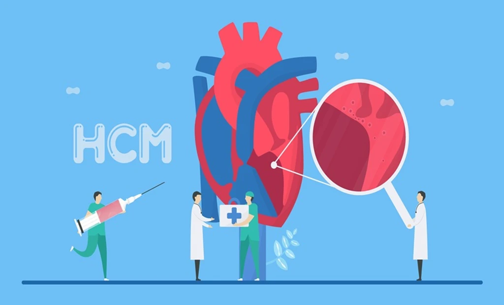 New Study Links Heart Failure to Poor Outcomes in Hypertrophic Cardiomyopathy
