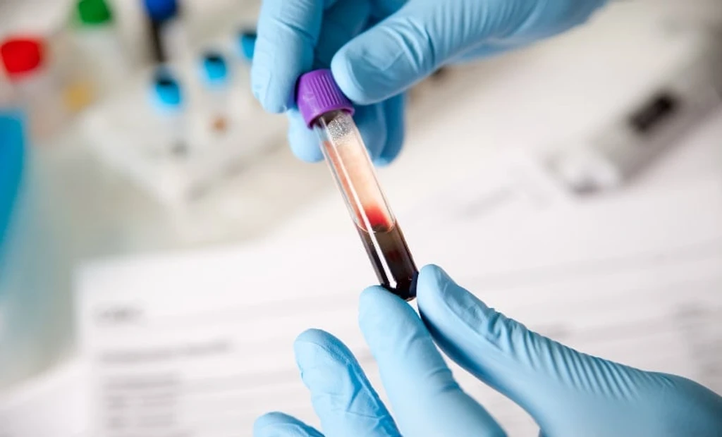 FIB-4 Index Falls Short in Detecting Liver Fibrosis in MASLD Patients