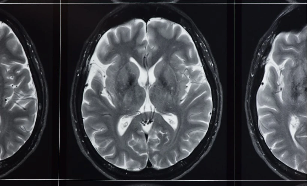 New MRI Tech Offers Sharper Brain Imaging