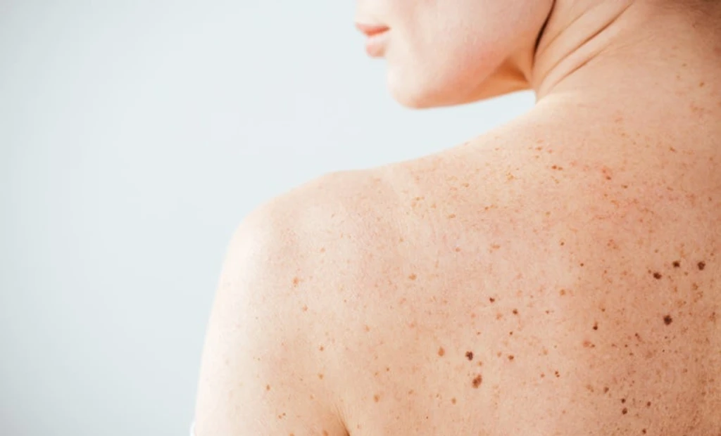New Immune Markers Could Predict Melanoma Aggression and Treatment Response