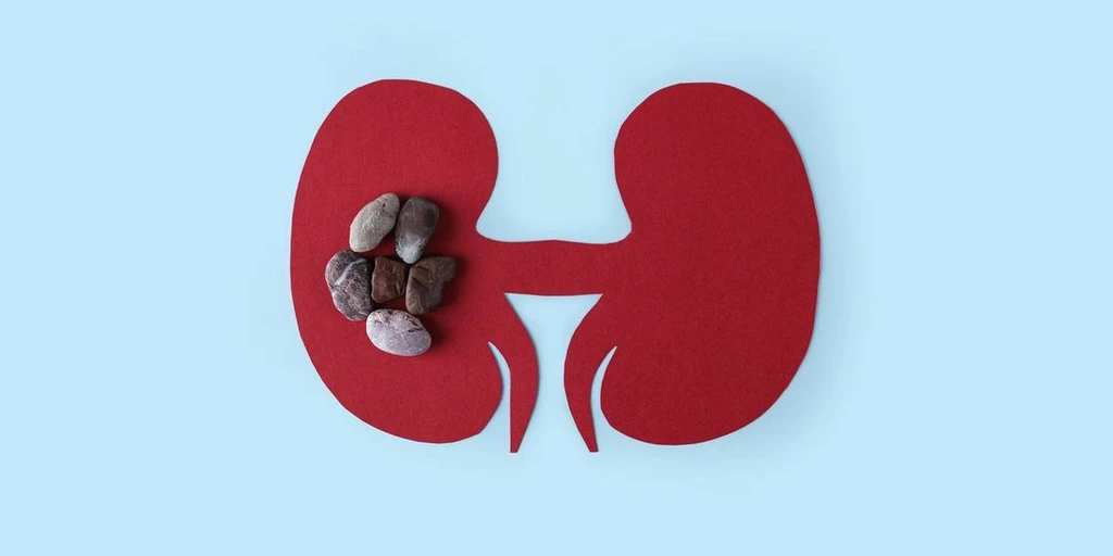 Kidney Stones: Understanding Causes, Symptoms, and Treatments