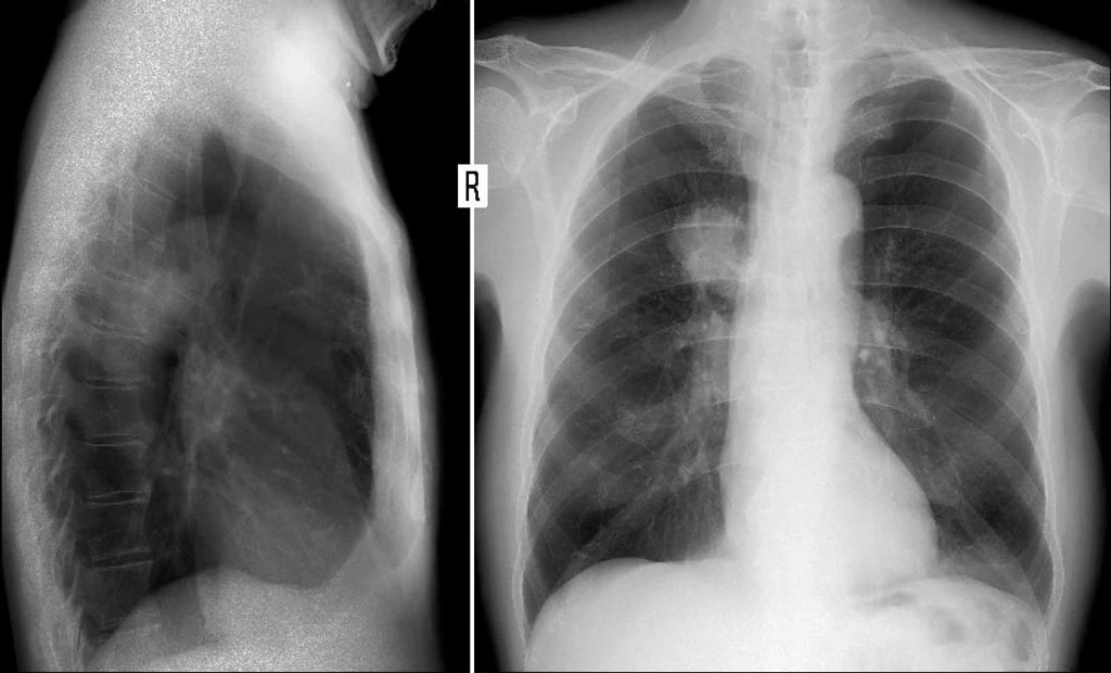 Major UK Study Reveals Stark Accuracy Differences in Lung Cancer AI Tools