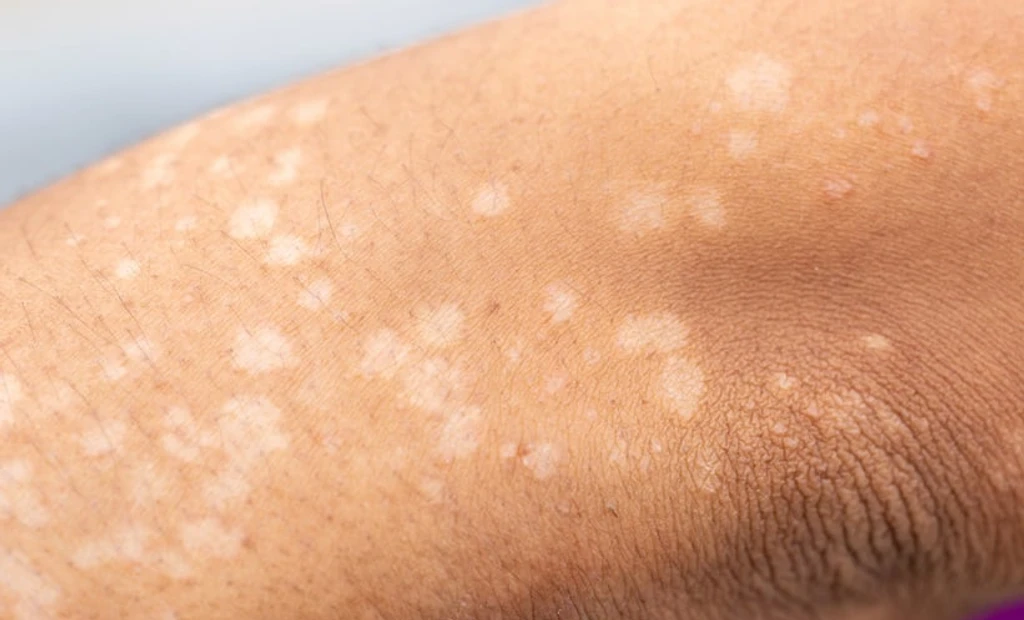 Lupus Treatment Shifts to Precision Immunotherapy
