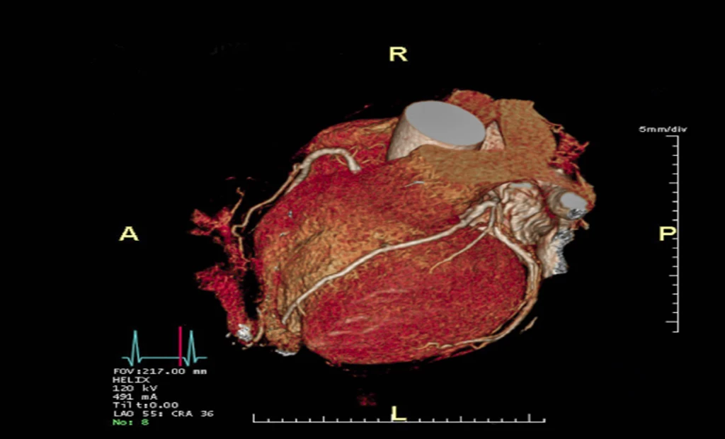 New Study Reveals Sex-Specific Differences in Heart Strain Measurements
