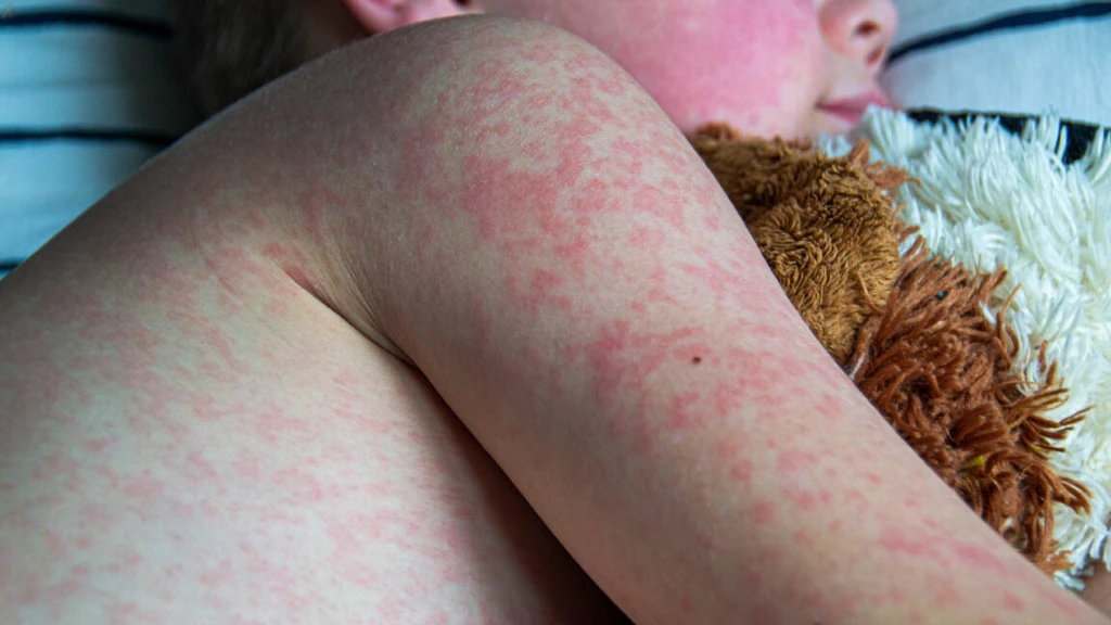 Texas Measles Study Reveals High Complication Rate in Hospitalized Patients