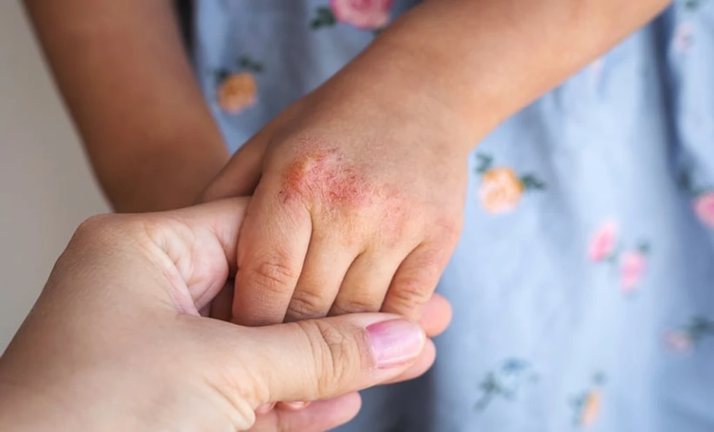 AI Predicts Childhood Asthma Risk From Eczema