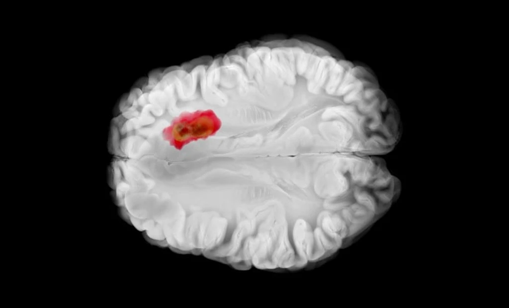 MULTIPLEX MRI Shows Promise in Glioma Grading and Molecular Subtyping