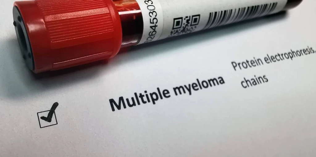 Multiple Myeloma: Early Signs and Treatment Advances