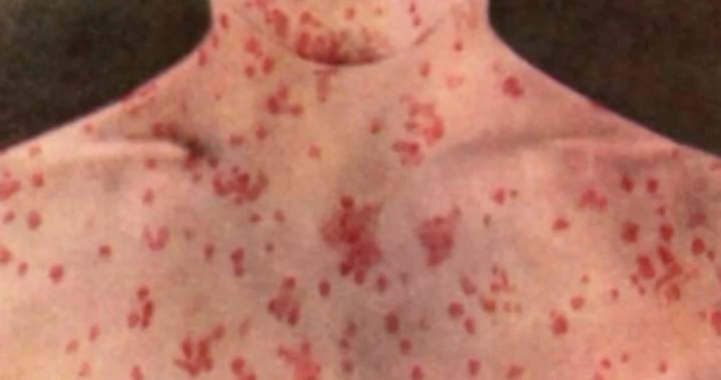 Measles Exposure Alert Issued for Pearson Airport Travelers