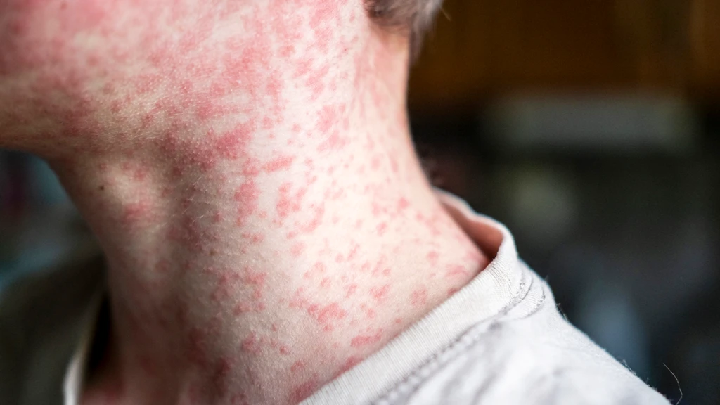 Measles Resurgence Signals National Health Crisis