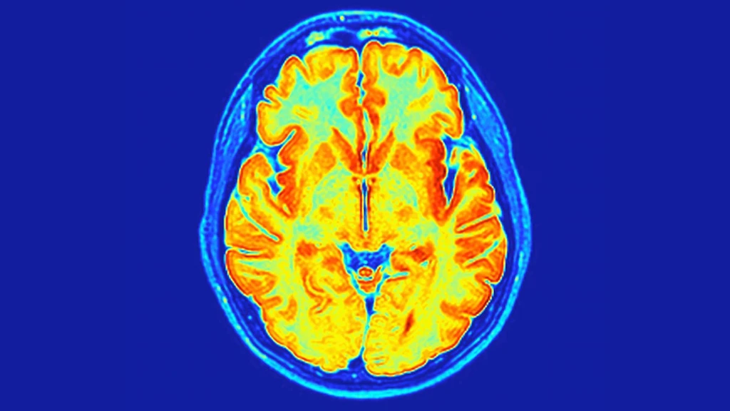 New Genetic Disorder Linked to RNU2-2 Gene Discovered