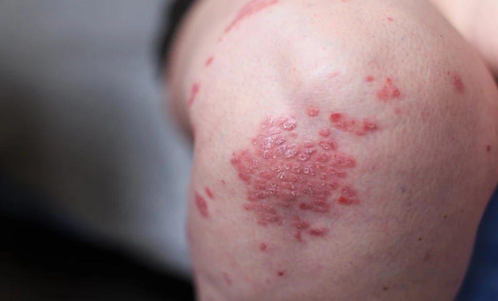 New Protein Target PA2G4 Shows Promise for Psoriasis Treatment