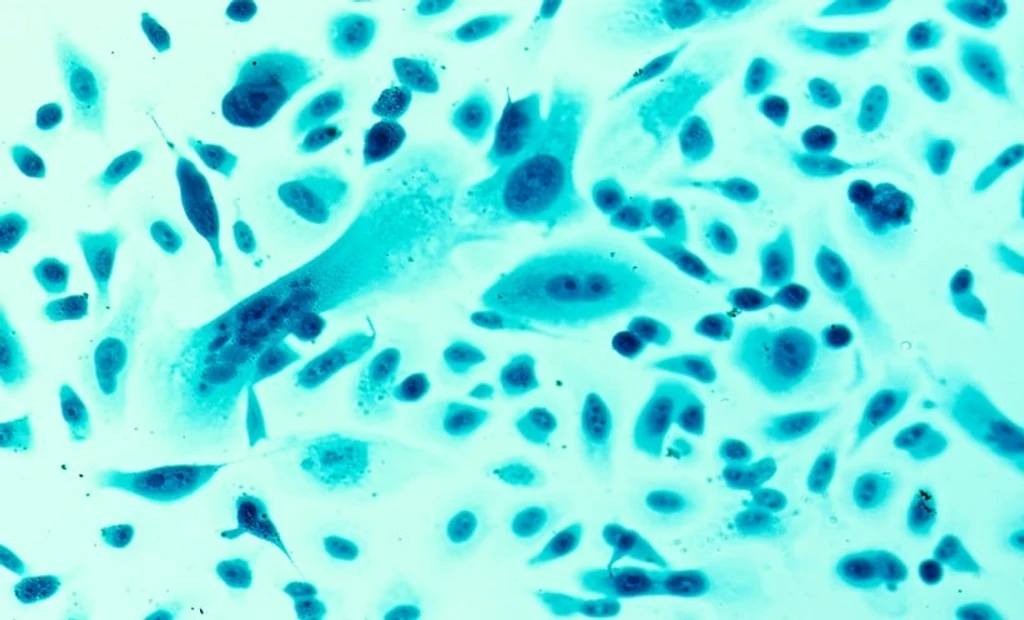 PRECISE MRI Score Refines Prostate Cancer Monitoring