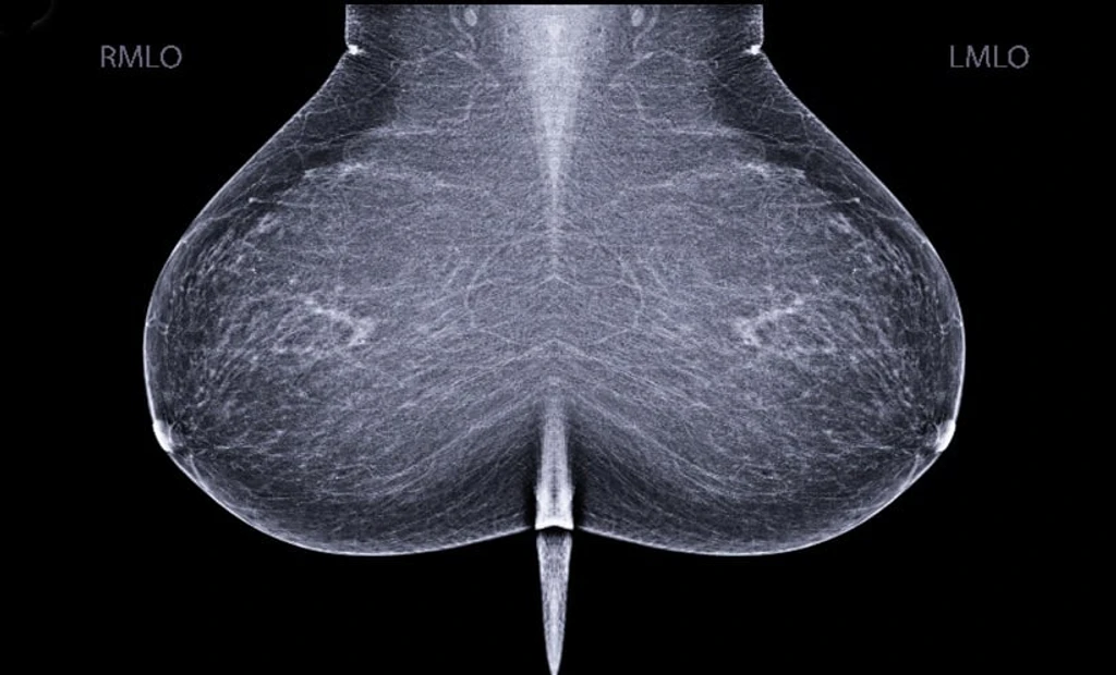 AI Mammography Results Undermine Patient Trust Without Context