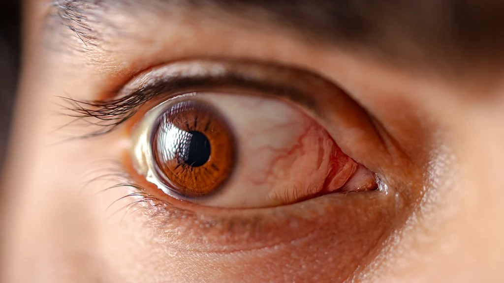 Spinach-Based Eye Drops Show Promise for Dry Eye Disease