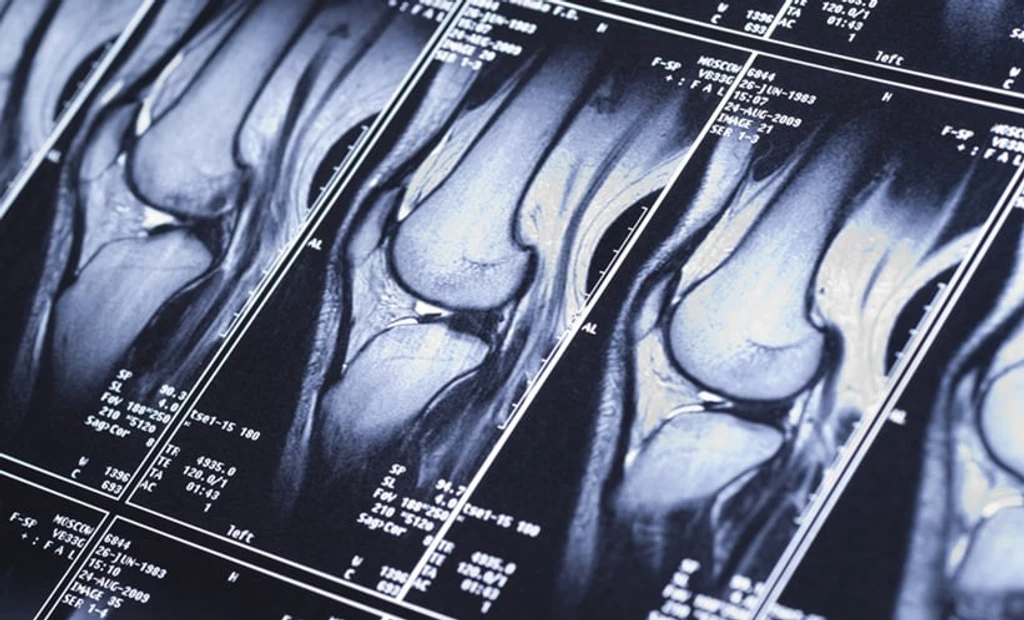Sacroiliac Bone Marrow Oedema Found in 30% of Healthy Adults